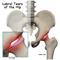 Treatment for Hip Labral Tears - Orthagenex